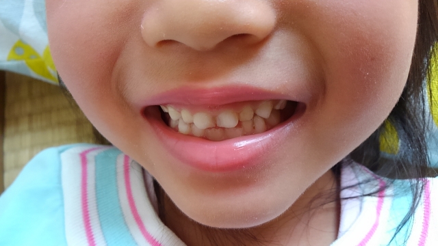 歯並び、出っ歯に影響するか